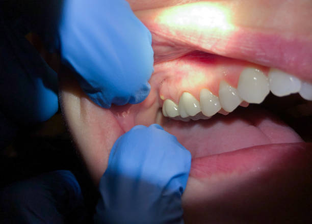 Best Emergency Dental Care for Abscessed Tooth in Shattuck, OK